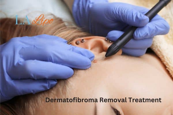 Dermatofibroma Removal Treatment South Woodford