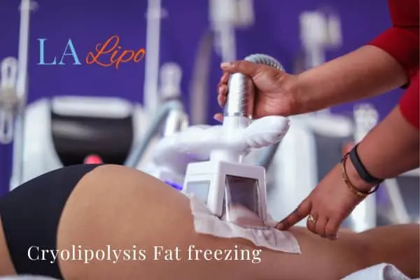 women getting fat freezing South Woodford