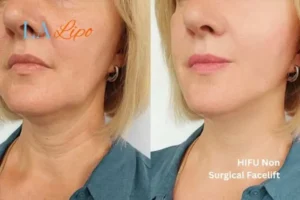 hi-fu for wrinkles South Woodford before and after results