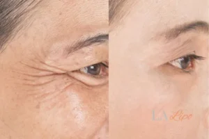 Before and after results of woman - HI-fu wrinkles reduction treatment South Woodford