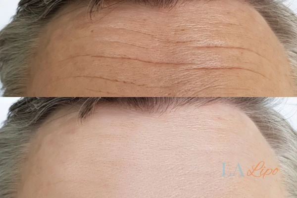 results of HIFU South Woodford on mans forehead to help reduce lines and wrinkles