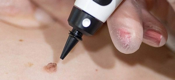 skin tag removal using cryopen South Woodford