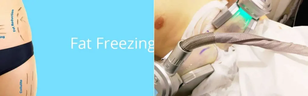 Fat freezing South Woodford on multiple areas of the body