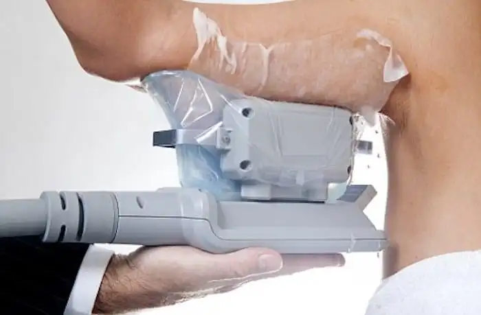 Picture of fat freezing South Woodford on the upper arms.