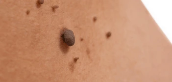 image of a skin tag South Woodford