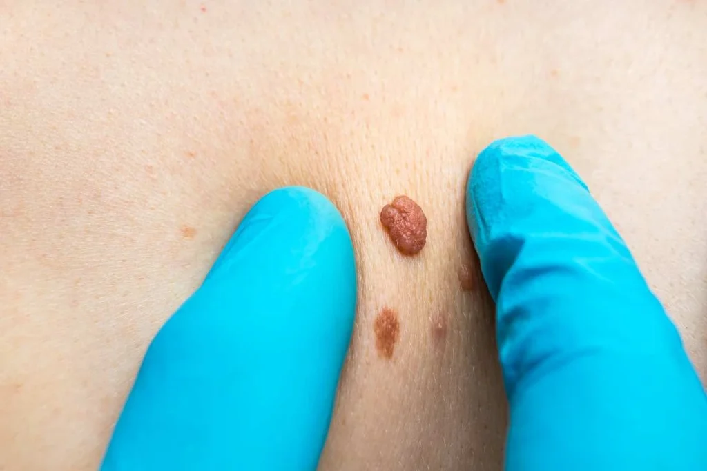Consultant examining a skin tag South Woodford