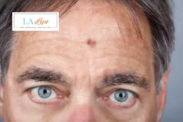 Solar Lentigo Removal South Woodford image of man with mark on his forehead