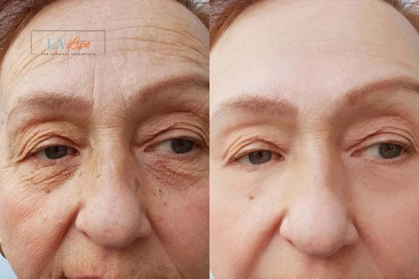 The powerful benefits of Morpheus8 Treatment South Woodford - Call Our team today!