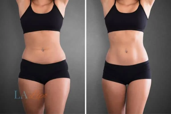before and after results of non-surgical treatment to help a woman's body image and mental health South Woodford