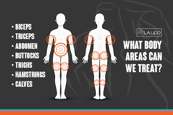 Diagram to show areas you can have LA-EMS Body Sculpting Treatment South Woodford